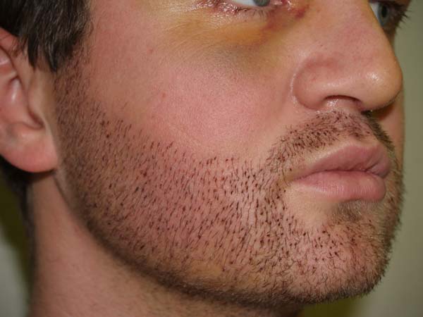 Facial Hair Transplant Pictures 45