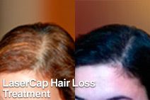 LaserCap Hair Loss Treatment