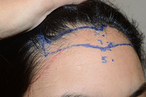 Marcar el avance de la línea del cabello del paciente