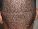 Dr. Epstein Hair Transplant Patient in NY