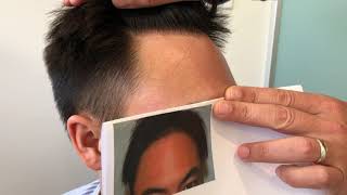 Asian patient one year after 1400 FUE grafts to create a more youthful hairline.