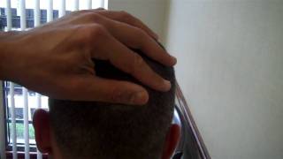 Dr. Epstein – FUE Hair Transplant 8 days Post-Op – Male Patient