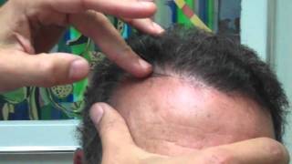 Dr. Jeffrey Epstein / Reparative Hair Transplant Procedure
