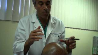 FUE Hair Transplant 1600 Grafts – Post-Op Day 1
