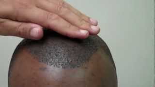 FUE Hair Transplant 4 Days After