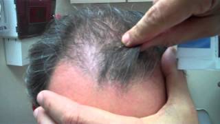 Hair Transplant – 2500 grafts