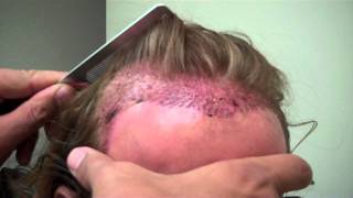 Hair Transplant procedure Post-Op Day 1 with 2800 grafts