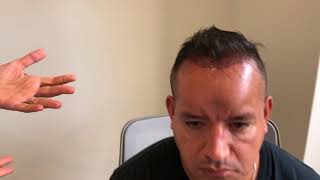 Happy patient describes his experience one day after FUE hair transplant.