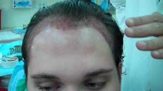 Jeffrey S. Epstein Hairline Procedure with 2750 grafts