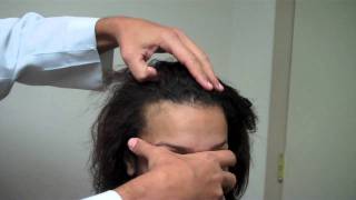 Mark Up for Surgical Hairline Advancement – Female Patient