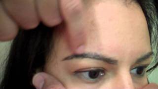 Post-Op Results of Eyebrow Transplant – Female Patient