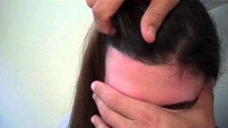 Avance de la línea del cabello / Reducción de la línea del cabello
