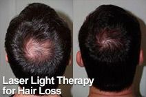 Laser Light Therapy for Hair Loss