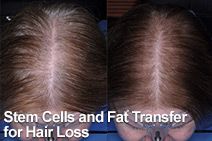 Growth Factors and Fat Transfer for Hair Loss