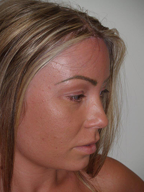 Hairline Advancement Oblique Right View After in Miami, Florida