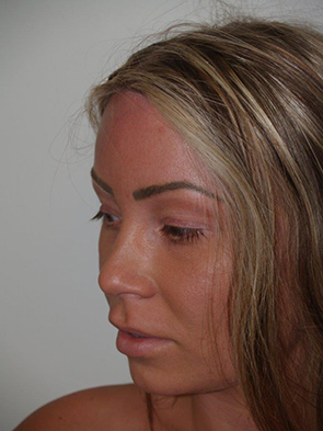 Hairline Advancement Oblique Left View After in Miami, Florida