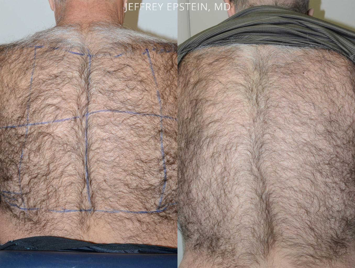 Body Hair Transplant Before and after in Miami, FL, Paciente 35167