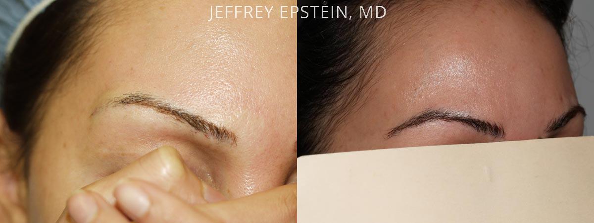 Eyebrow Hair Transplant Before and after in Miami, FL, Paciente 36530
