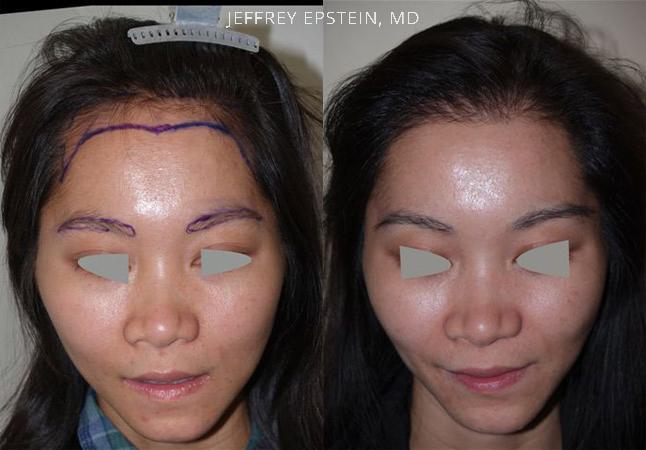 Forehead Reduction Surgery Before and after in Miami, FL, Paciente 37166