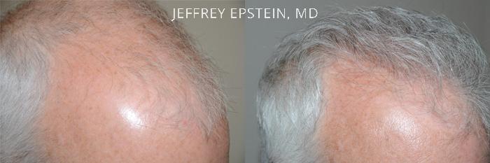Hair Transplants for Men Before and after in Miami, FL, Paciente 40106