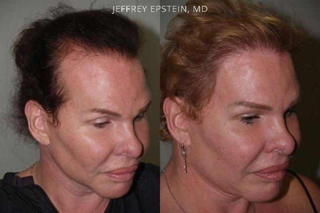 Special Cases Before and after in Miami, FL, Paciente 41094