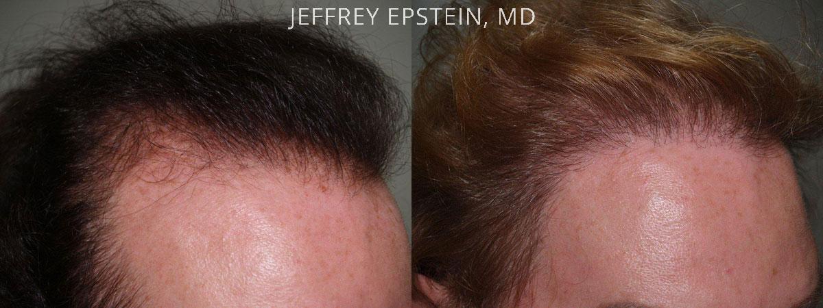 Special Cases Before and after in Miami, FL, Paciente 41094