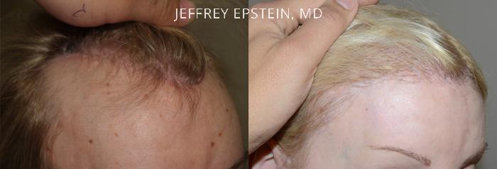 Special Cases Before and after in Miami, FL, Paciente 41294