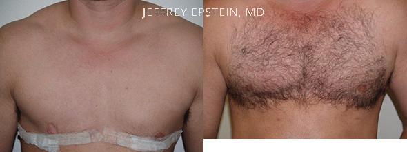 Trasplante de Pelo Transgenero Before and after in Miami, FL, Paciente 94324