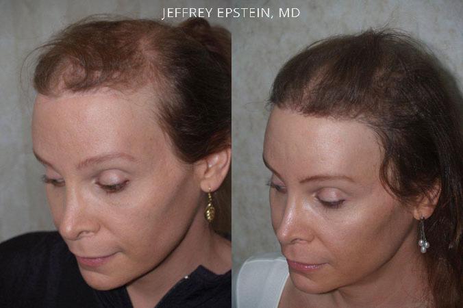Hair Transplants for Gender Reaffirmation Before and after in Miami, FL, Paciente 41314