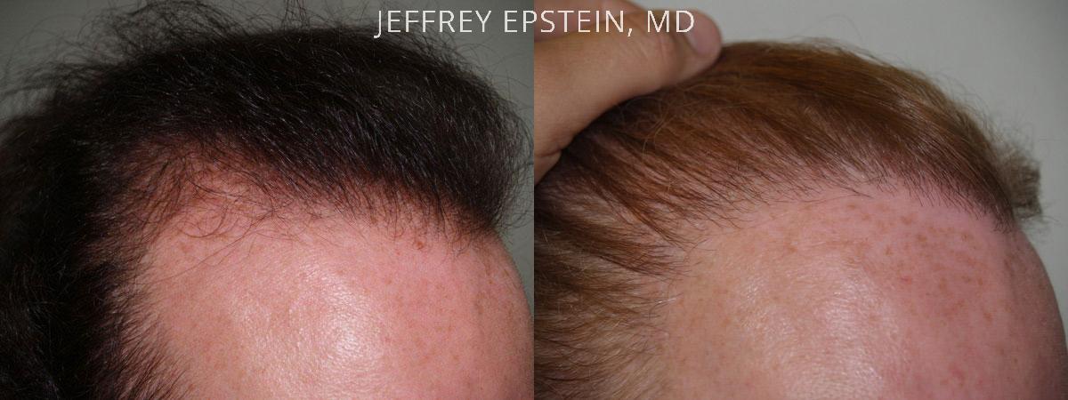 Hair Transplants for Gender Reaffirmation Before and after in Miami, FL, Paciente 41339