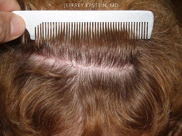 Hair Transplants for Gender Reaffirmation Before and after in Miami, FL, Paciente 41339