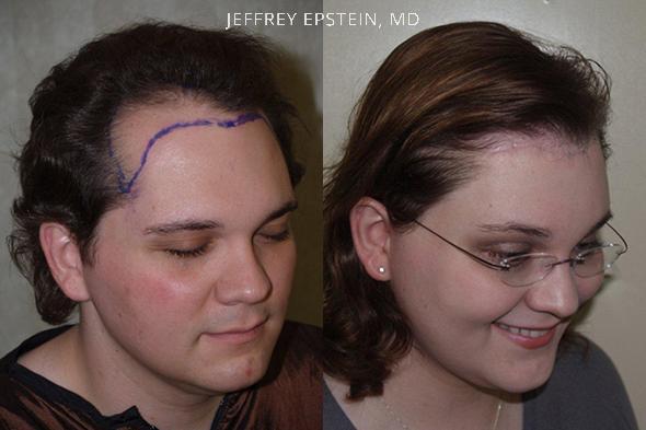 Hair Transplants for Gender Reaffirmation Before and after in Miami, FL, Paciente 41370