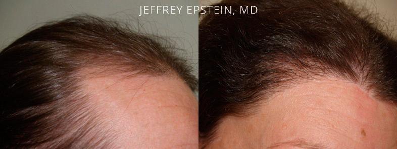 Hair Transplants for Gender Reaffirmation Before and after in Miami, FL, Paciente 41383
