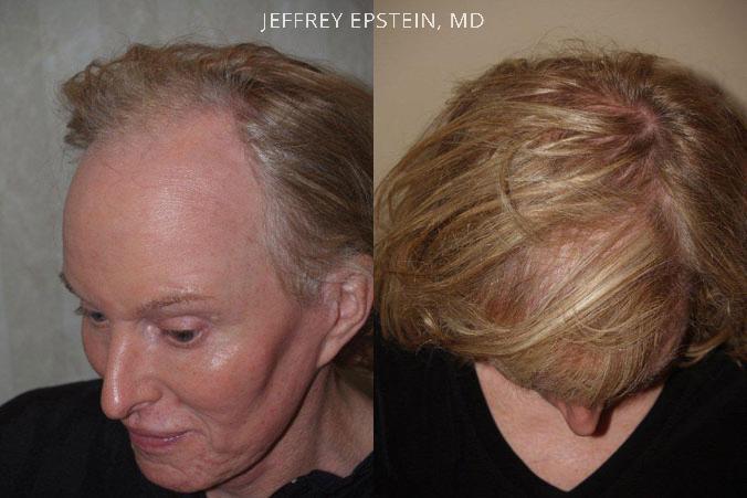 Hair Transplants for Gender Reaffirmation Before and after in Miami, FL, Paciente 41320