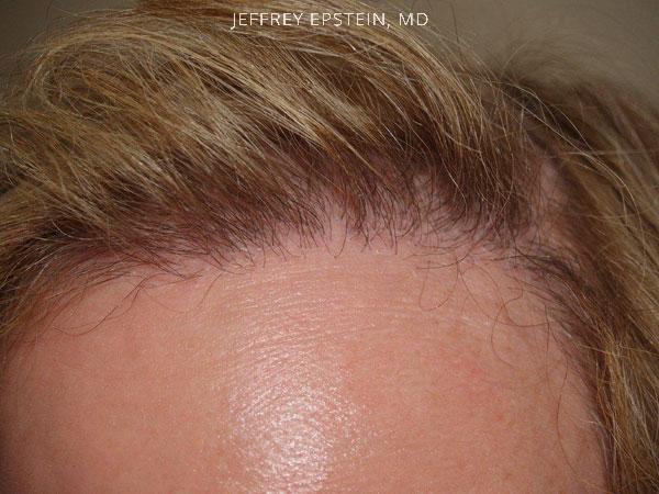 Hair Transplants for Gender Reaffirmation Before and after in Miami, FL, Paciente 41320