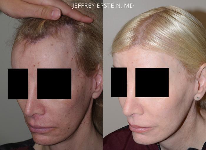 Hair Transplants for Gender Reaffirmation Before and after in Miami, FL, Paciente 41354