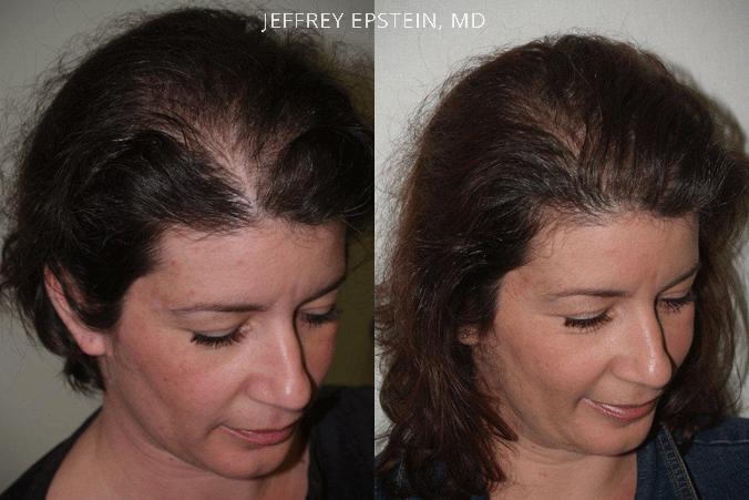 Hair Transplants for Women Before and after in Miami, FL, Paciente 41821