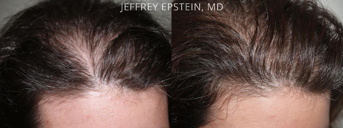Hair Transplants for Women Before and after in Miami, FL, Paciente 41821