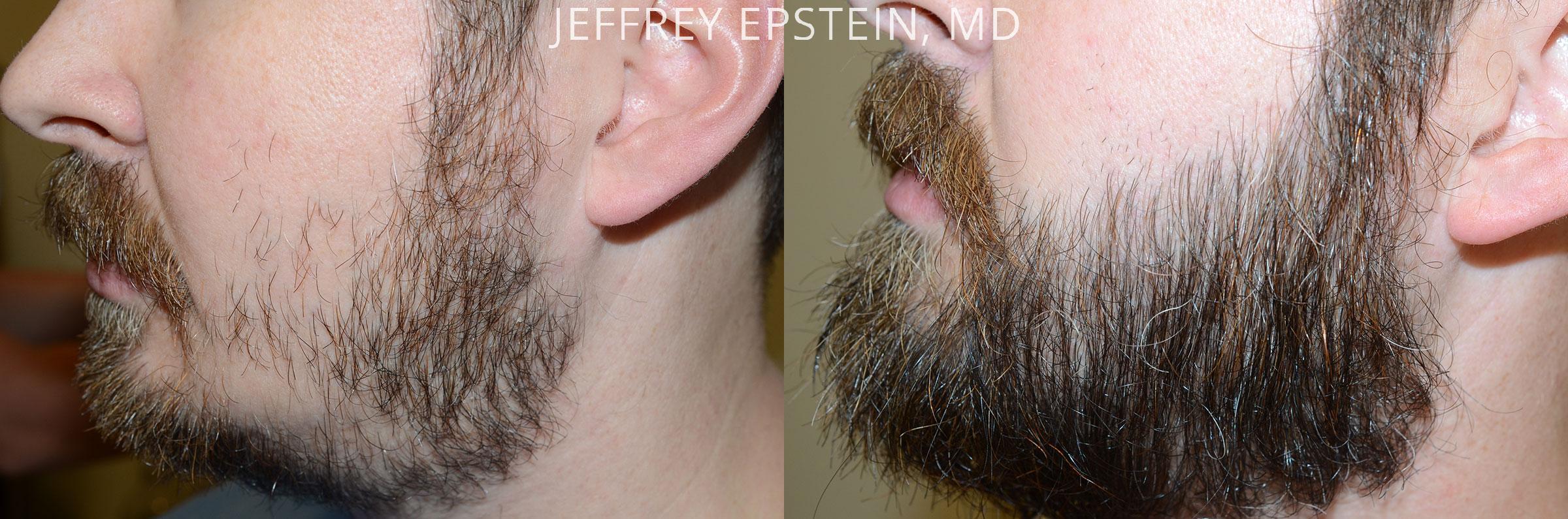 Facial Hair Before and after in Miami, FL, Paciente 47524
