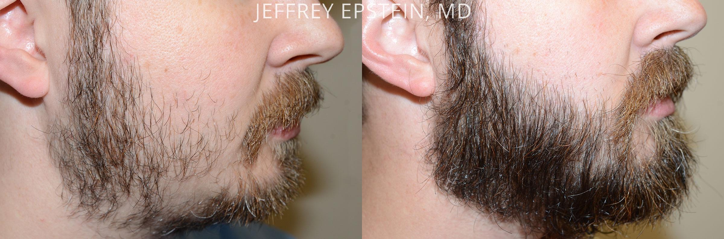 Trasplante de Pelo Facial Antes y después en Miami, FL, Paciente 71268