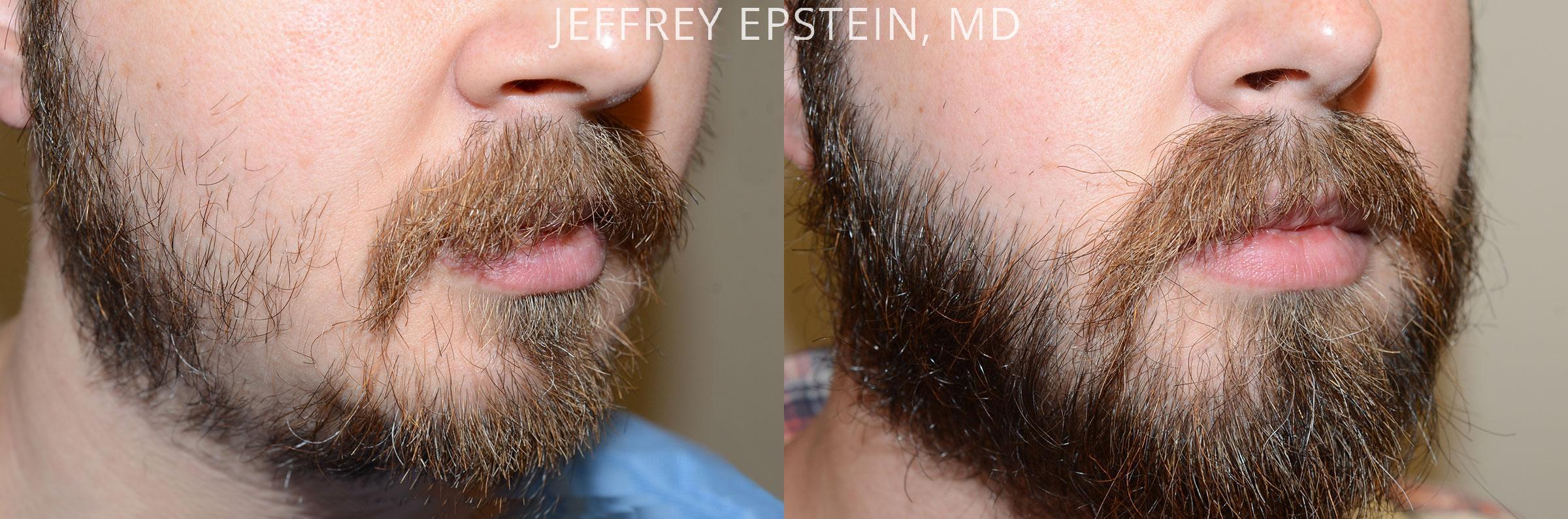 Facial Hair Transplant Before and after in Miami, FL, Paciente 47524