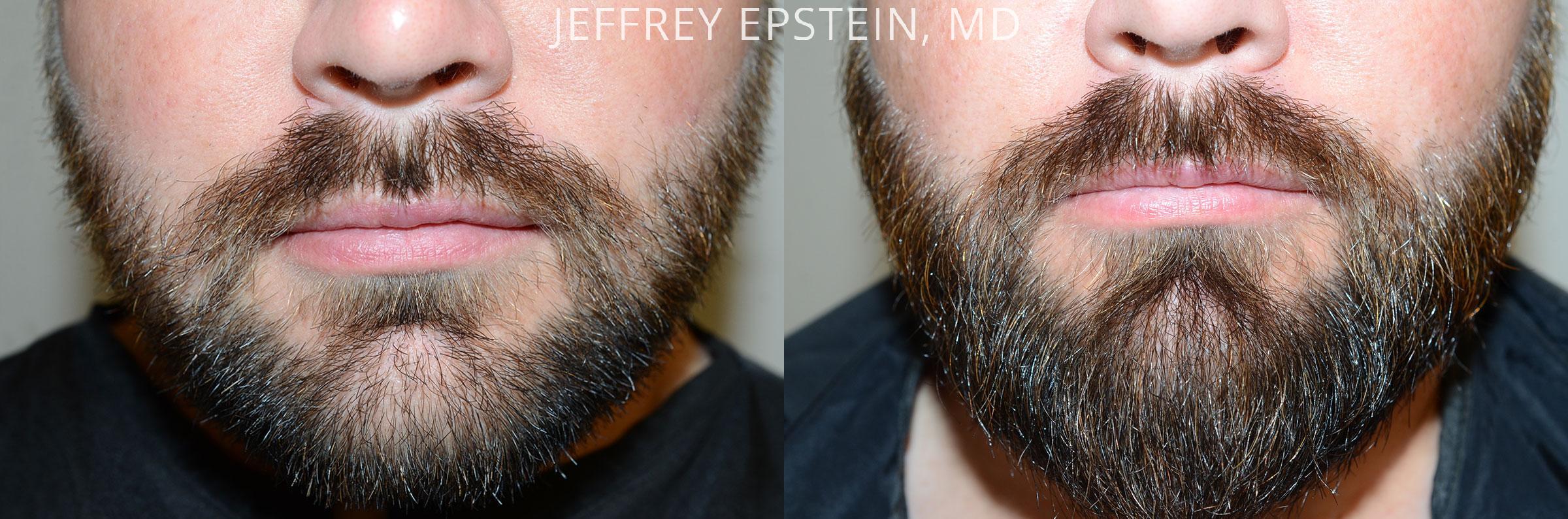 Facial Hair Transplant Before and after in Miami, FL, Paciente 47594