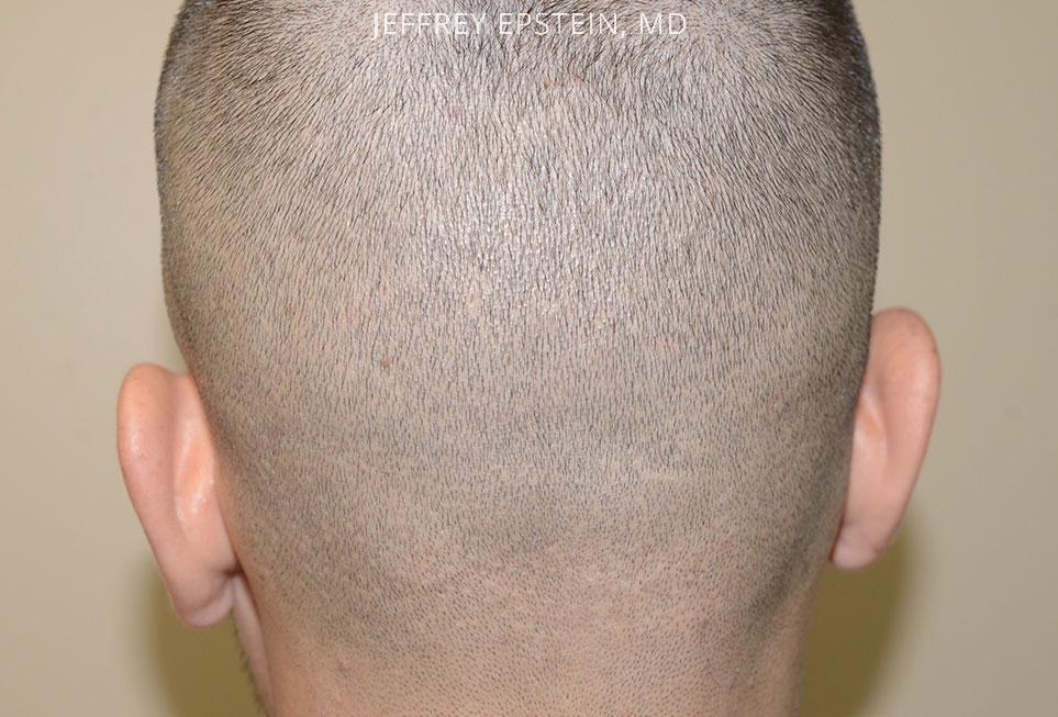 Hair Transplants for Men Before and after in Miami, FL, Paciente 47618
