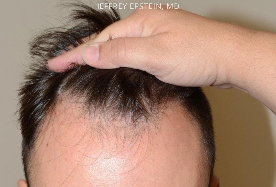 Hair Transplants for Men Before and after in Miami, FL, Paciente 47618