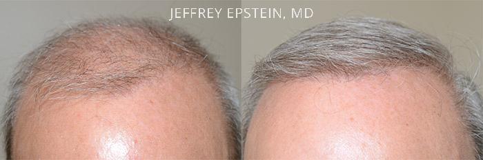 Hair Transplants for Men Before and after in Miami, FL, Paciente 40189