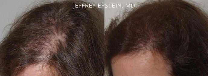 Hair Transplants for Women Before and after in Miami, FL, Paciente 47722