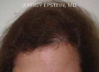 Hair Transplants for Women Before and after in Miami, FL, Paciente 47722