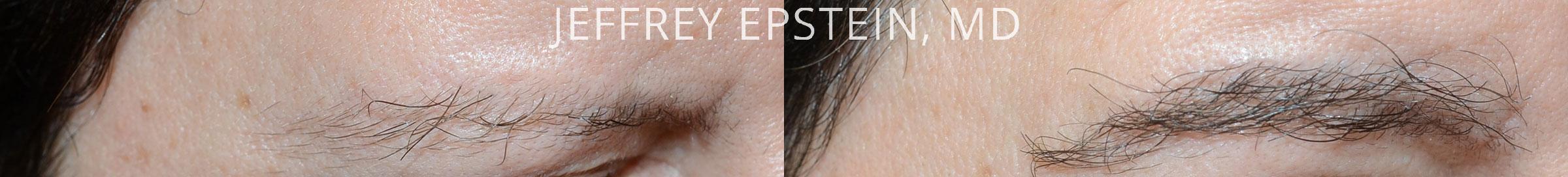 Eyebrow Hair Transplant Before and after in Miami, FL, Paciente 47758