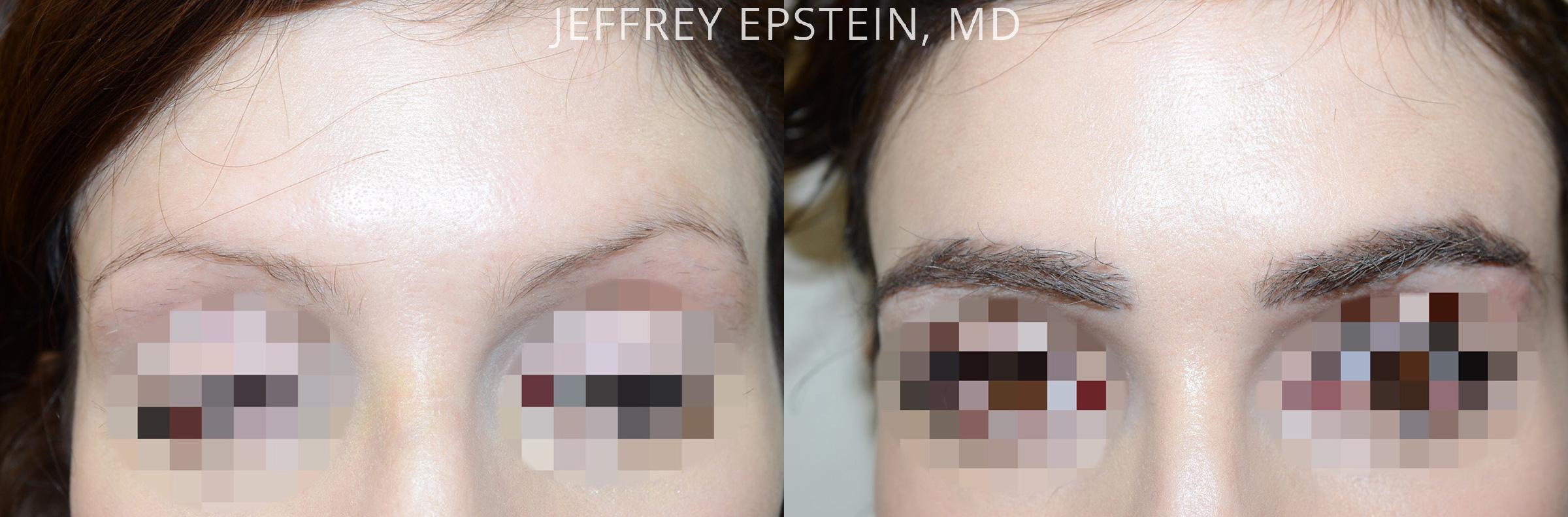Trasplante de Cejas Before and after in , , Paciente 65390