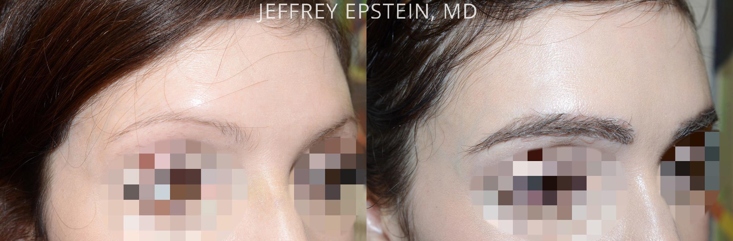Trasplante de Cejas Before and after in , , Paciente 65390